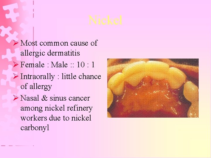 Nickel Ø Most common cause of allergic dermatitis Ø Female : Male : :