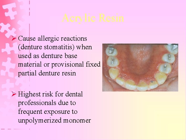 Acrylic Resin Ø Cause allergic reactions (denture stomatitis) when used as denture base material
