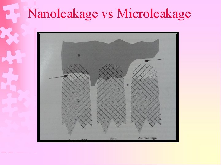 Nanoleakage vs Microleakage 