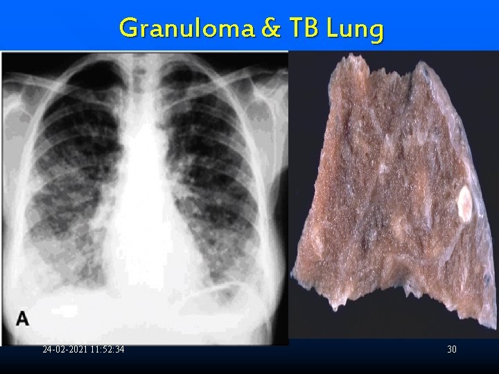 Granuloma & TB Lung 24 -02 -2021 11: 52: 34 30 