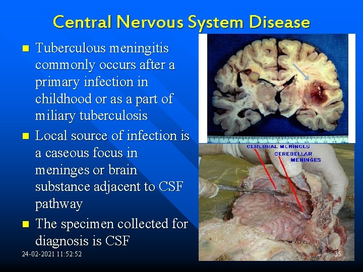 Central Nervous System Disease n n n Tuberculous meningitis commonly occurs after a primary
