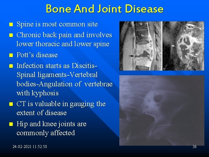 Bone And Joint Disease n n n Spine is most common site Chronic back