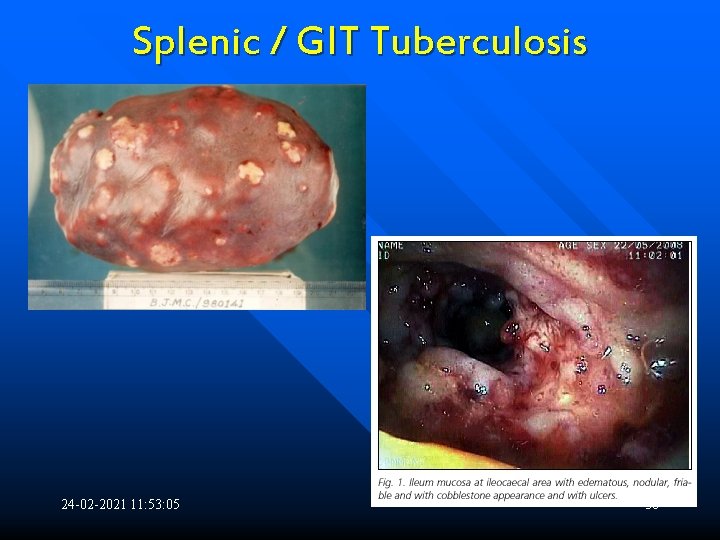 Splenic / GIT Tuberculosis 24 -02 -2021 11: 53: 05 38 