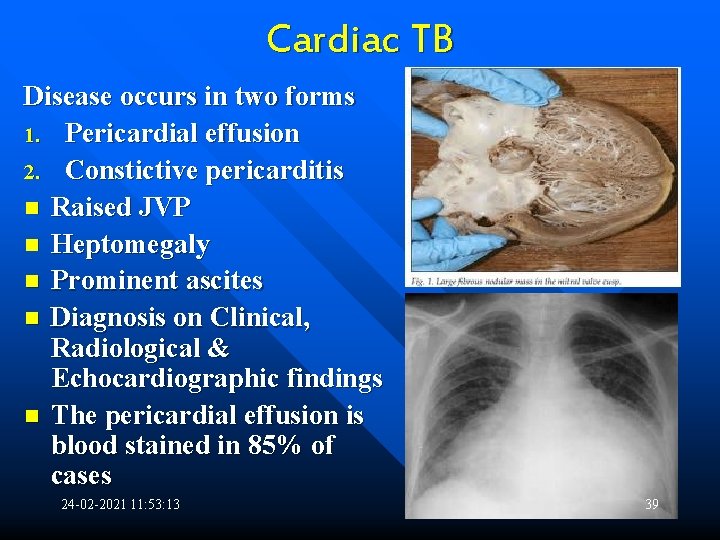 Cardiac TB Disease occurs in two forms 1. Pericardial effusion 2. Constictive pericarditis n