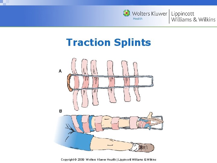 Traction Splints Copyright © 2009 Wolters Kluwer Health | Lippincott Williams & Wilkins 