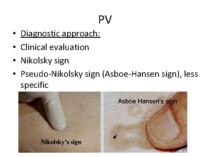 PV • • Diagnostic approach: Clinical evaluation Nikolsky sign Pseudo-Nikolsky sign (Asboe-Hansen sign), less