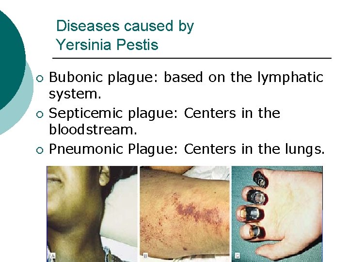Diseases caused by Yersinia Pestis ¡ ¡ ¡ Bubonic plague: based on the lymphatic