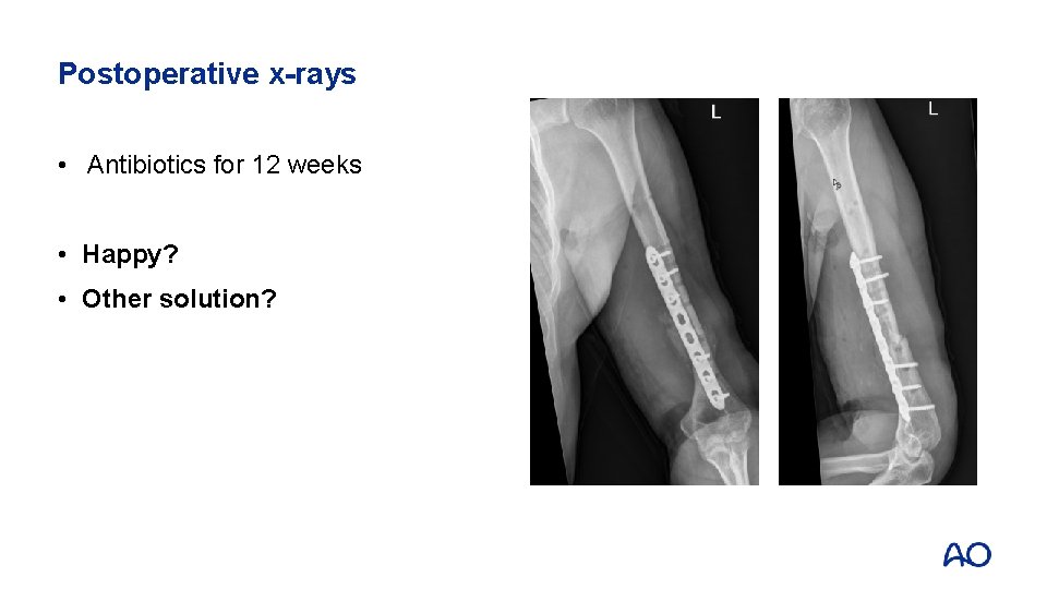 Postoperative x-rays • Antibiotics for 12 weeks • Happy? • Other solution? 