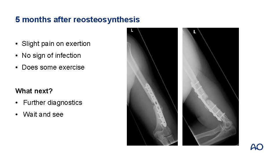 5 months after reosteosynthesis • Slight pain on exertion • No sign of infection