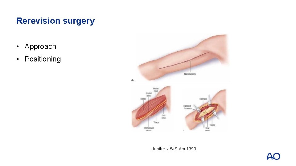 Rerevision surgery • Approach • Positioning Jupiter. JBJS Am 1990 