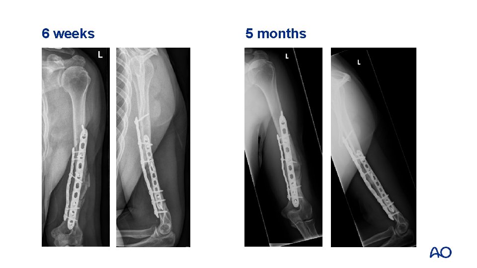 6 weeks 5 months 