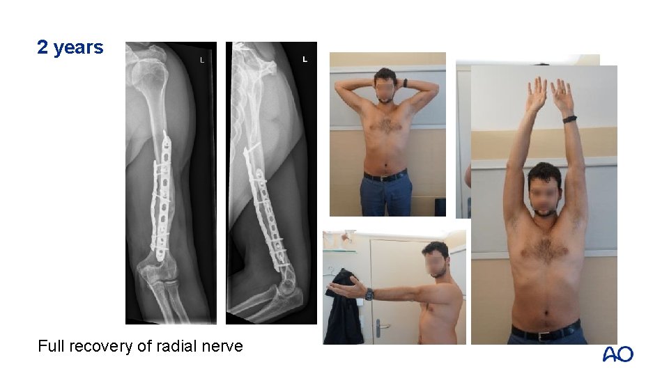 2 years Full recovery of radial nerve 