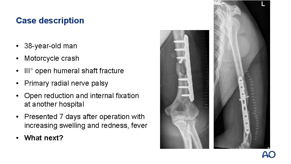 Case description • 38 -year-old man • Motorcycle crash • III° open humeral shaft