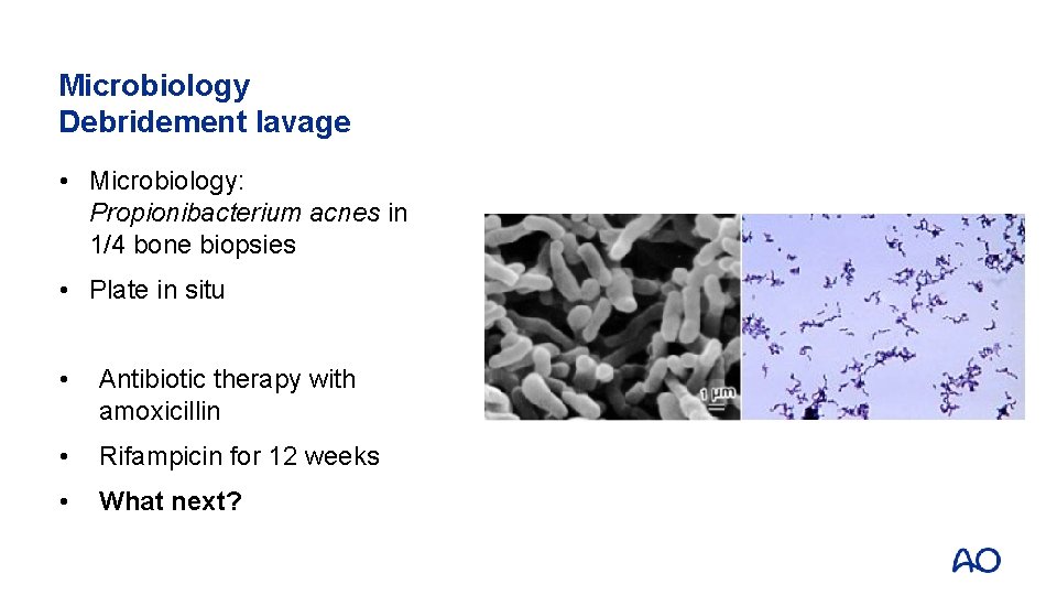 Microbiology Debridement lavage • Microbiology: Propionibacterium acnes in 1/4 bone biopsies • Plate in