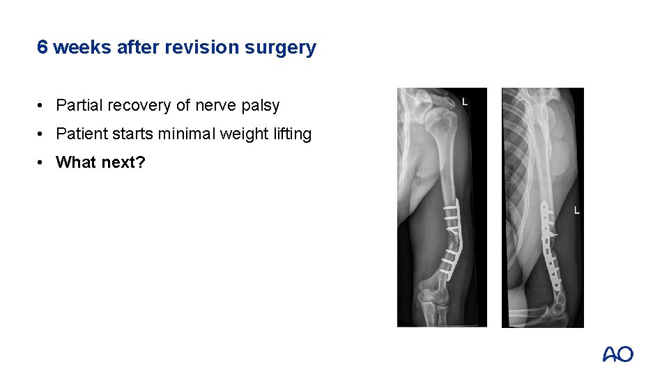 6 weeks after revision surgery • Partial recovery of nerve palsy • Patient starts