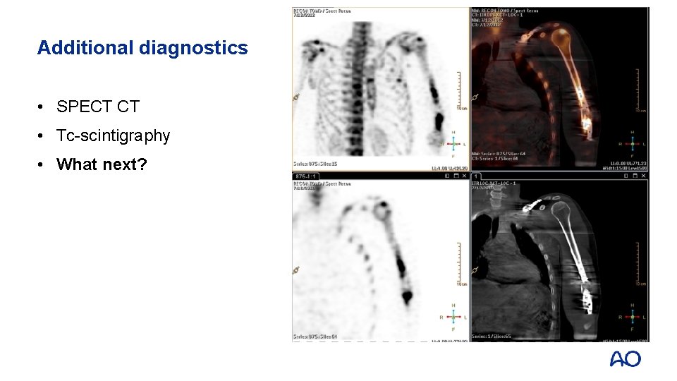 Additional diagnostics • SPECT CT • Tc-scintigraphy • What next? 