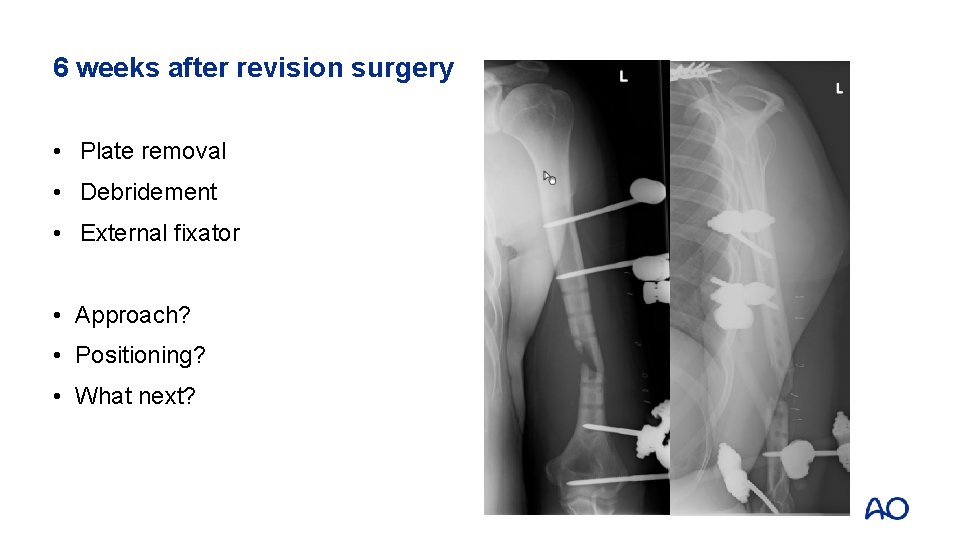 6 weeks after revision surgery • Plate removal • Debridement • External fixator •