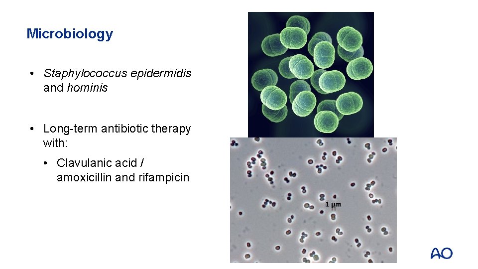 Microbiology • Staphylococcus epidermidis and hominis • Long-term antibiotic therapy with: • Clavulanic acid