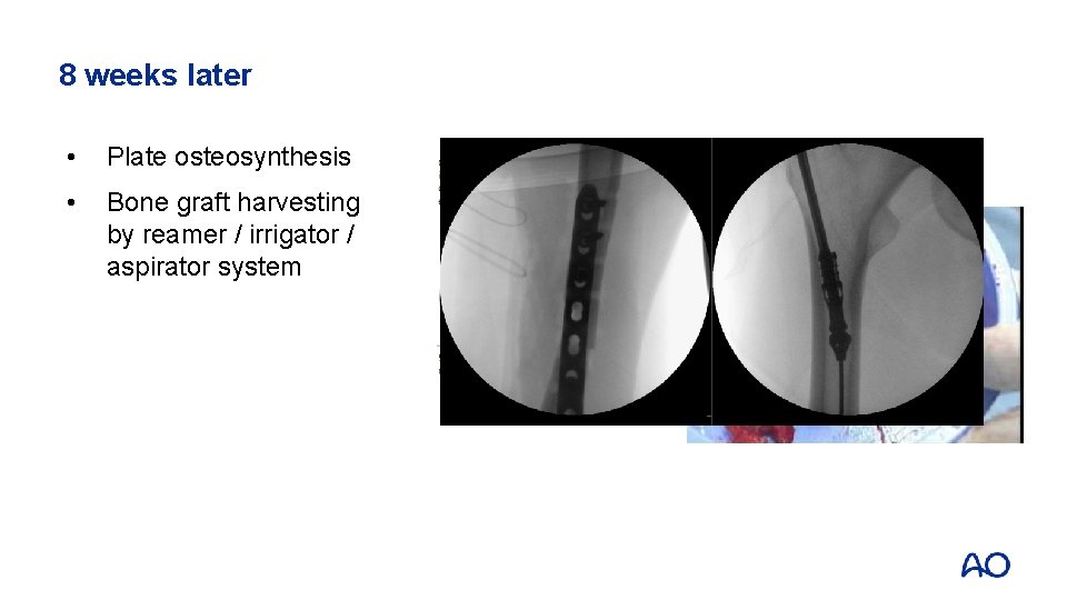 8 weeks later • Plate osteosynthesis • Bone graft harvesting by reamer / irrigator