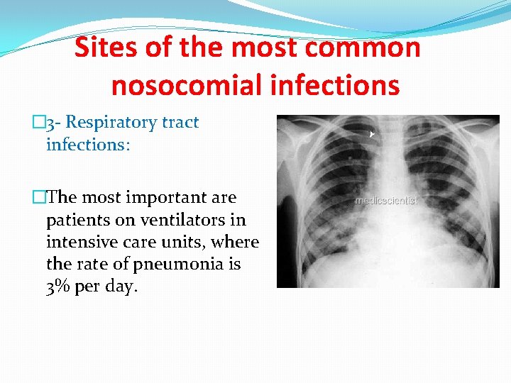 Sites of the most common nosocomial infections � 3 - Respiratory tract infections: �The