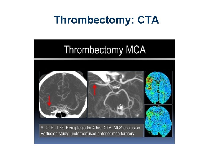 Thrombectomy: CTA 