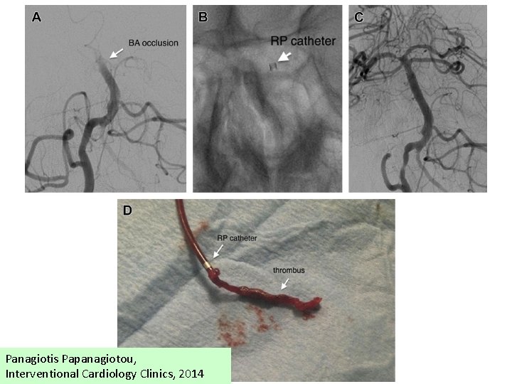 Panagiotis Papanagiotou, Interventional Cardiology Clinics, 2014 