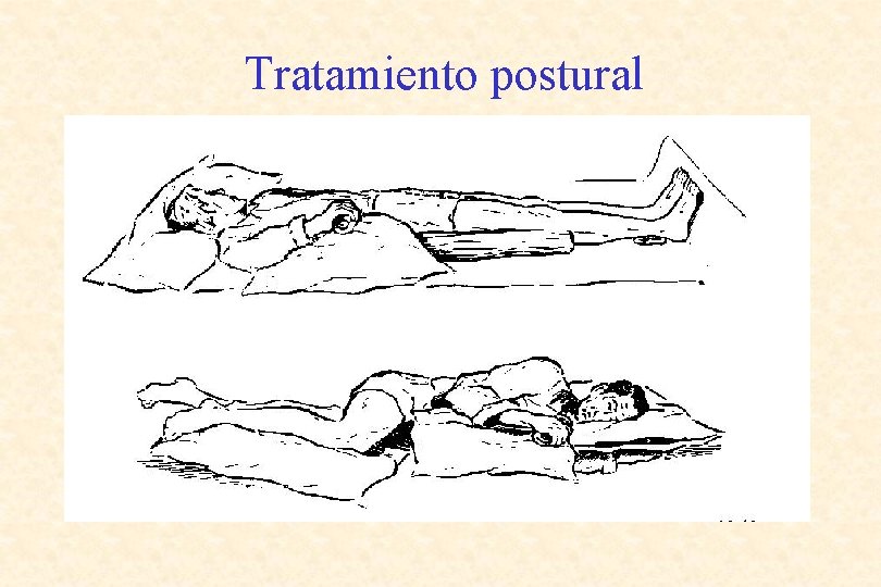 Tratamiento postural 