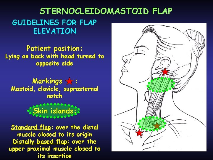 STERNOCLEIDOMASTOID FLAP GUIDELINES FOR FLAP ELEVATION Patient position: Lying on back with head turned