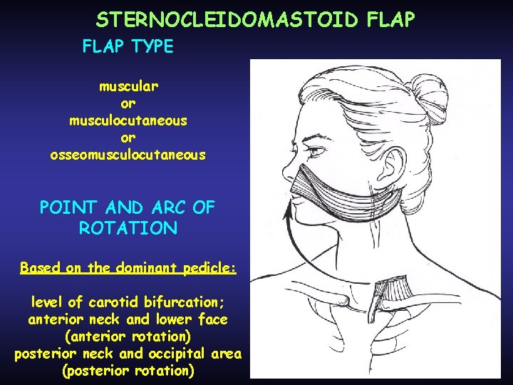 STERNOCLEIDOMASTOID FLAP TYPE muscular or musculocutaneous or osseomusculocutaneous POINT AND ARC OF ROTATION Based