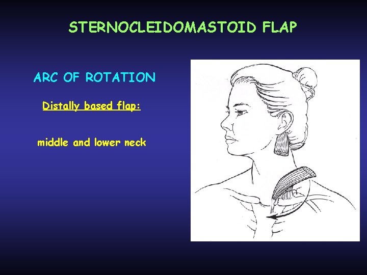 STERNOCLEIDOMASTOID FLAP ARC OF ROTATION Distally based flap: middle and lower neck 