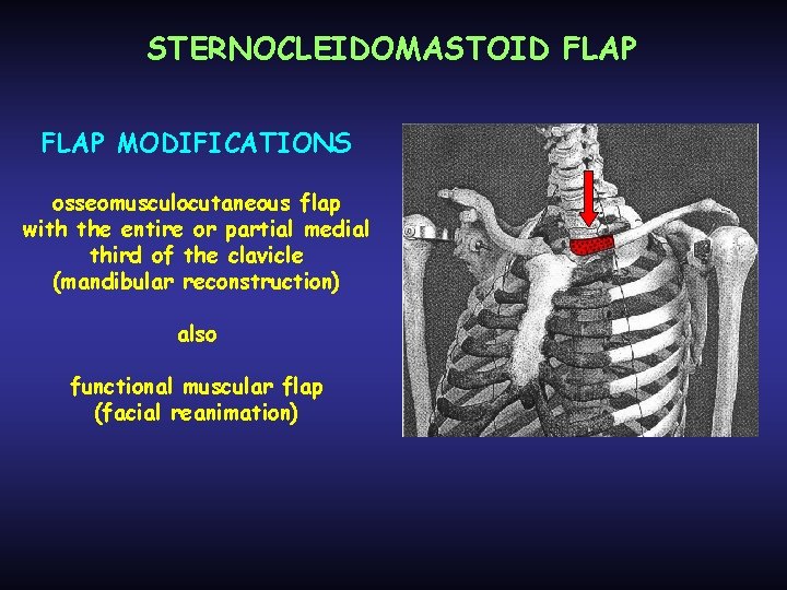 STERNOCLEIDOMASTOID FLAP MODIFICATIONS osseomusculocutaneous flap with the entire or partial medial third of the