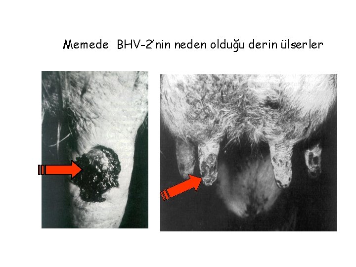 Memede BHV-2’nin neden olduğu derin ülserler 