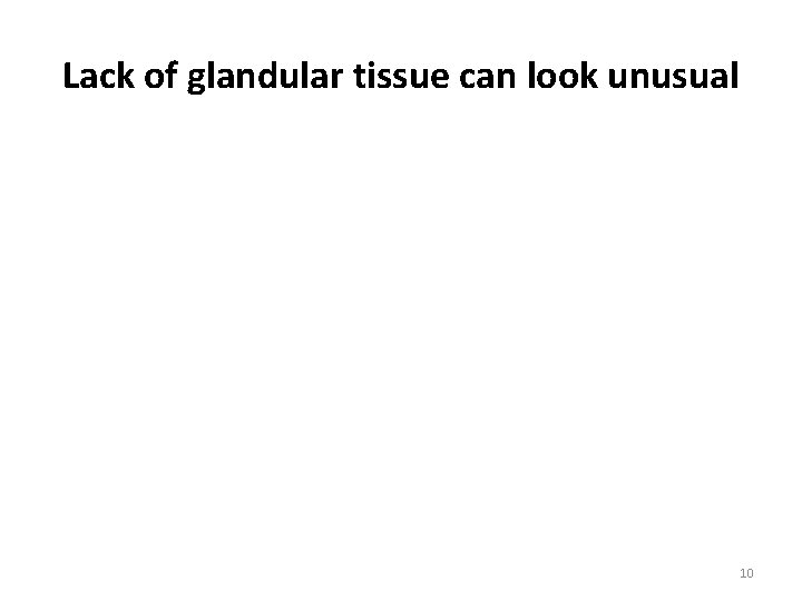 Lack of glandular tissue can look unusual www. 007 b. com 10 Lack of glandular tissue can look unusual www. 007 b. com 10