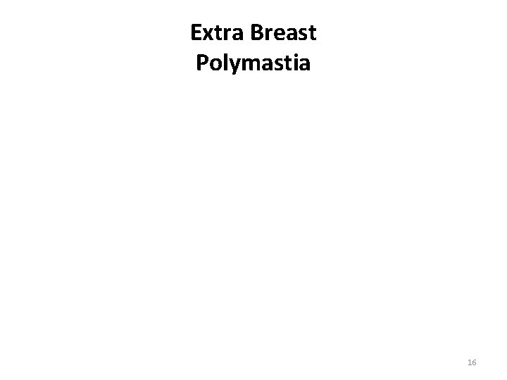 Extra Breast Polymastia © 1999 K Hoover r 16 Extra Breast Polymastia © 1999 K Hoover r 16