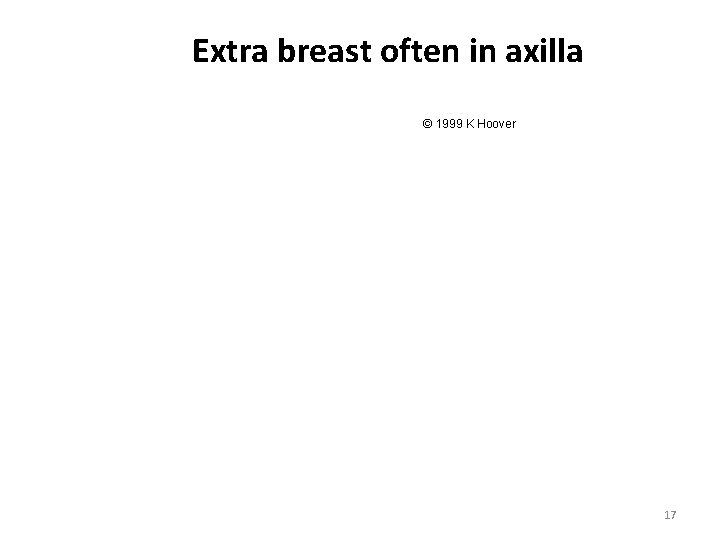 Extra breast often in axilla © 1999 K Hoover 17 Extra breast often in axilla © 1999 K Hoover 17