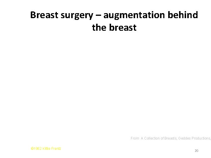 Breast surgery – augmentation behind the breast From A Collection of Breasts, Geddes Productions, Breast surgery – augmentation behind the breast From A Collection of Breasts, Geddes Productions,