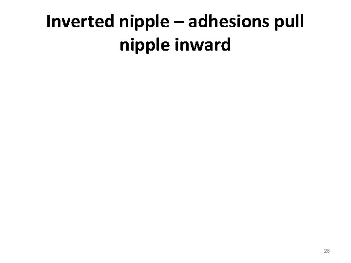 Inverted nipple – adhesions pull nipple inward © 1999 K Hoover 28 Inverted nipple – adhesions pull nipple inward © 1999 K Hoover 28