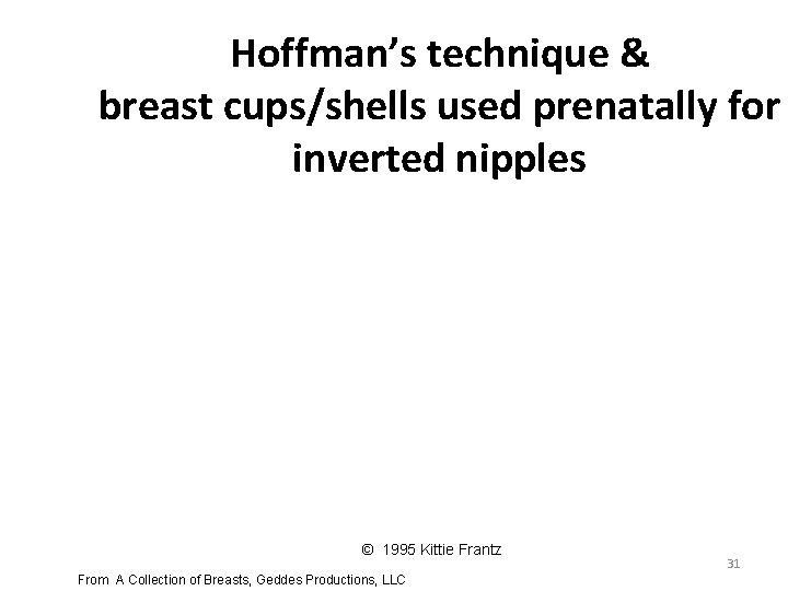 Hoffman’s technique & breast cups/shells used prenatally for inverted nipples © 1995 Kittie Frantz Hoffman’s technique & breast cups/shells used prenatally for inverted nipples © 1995 Kittie Frantz