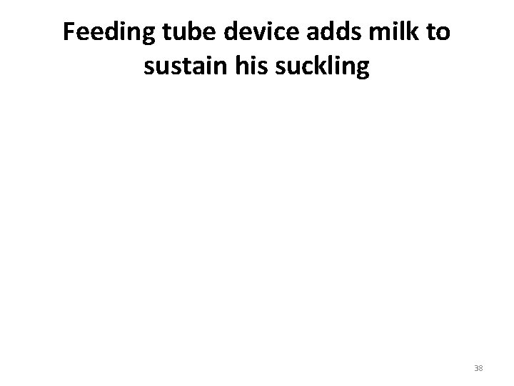 Feeding tube device adds milk to sustain his suckling Medela Ag 38 Feeding tube device adds milk to sustain his suckling Medela Ag 38