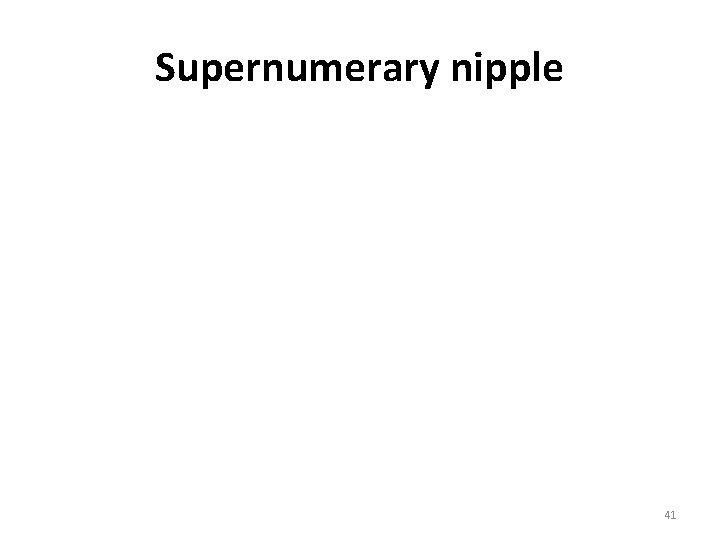 Supernumerary nipple © 1999 K Hoover 41 Supernumerary nipple © 1999 K Hoover 41