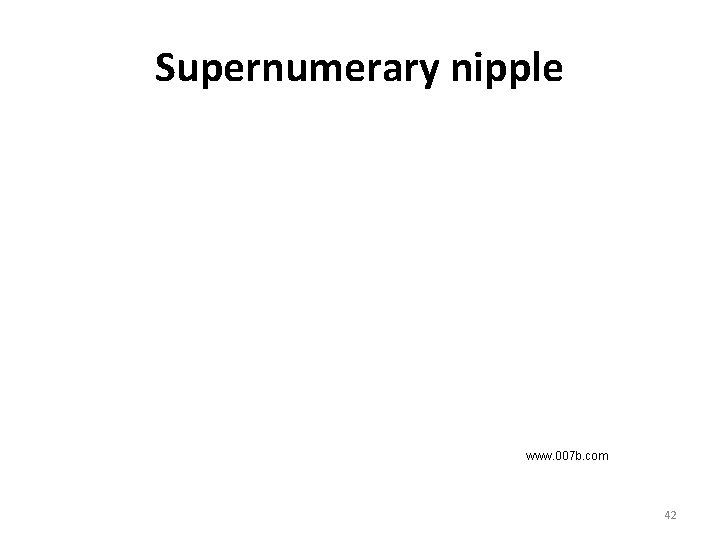 Supernumerary nipple www. 007 b. com 42 Supernumerary nipple www. 007 b. com 42