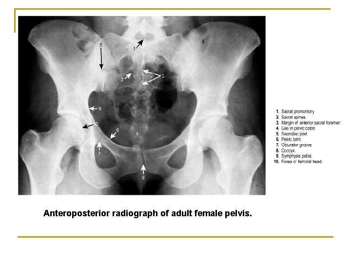 Anteroposterior radiograph of adult female pelvis. 