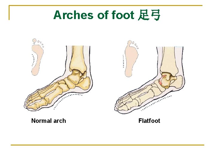 Arches of foot 足弓 Normal arch Flatfoot 