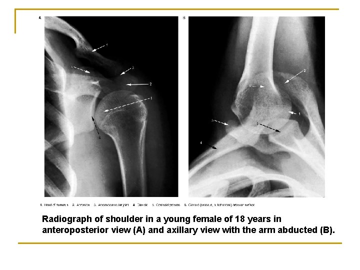 Radiograph of shoulder in a young female of 18 years in anteroposterior view (A)