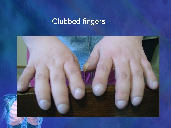 Clubbed fingers 