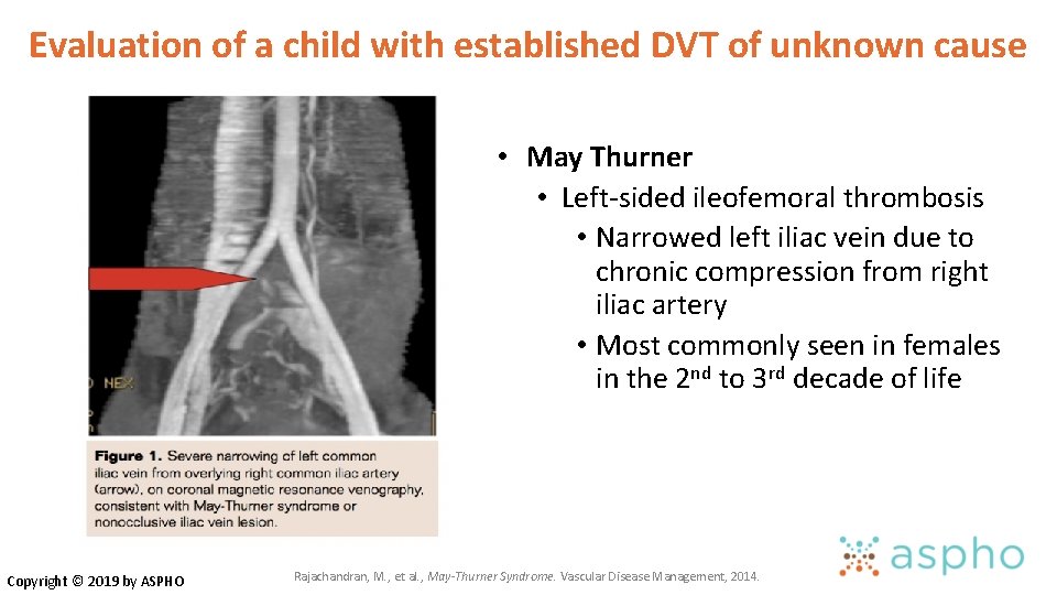 Evaluation of a child with established DVT of unknown cause Copyright © 2019 by Evaluation of a child with established DVT of unknown cause Copyright © 2019 by