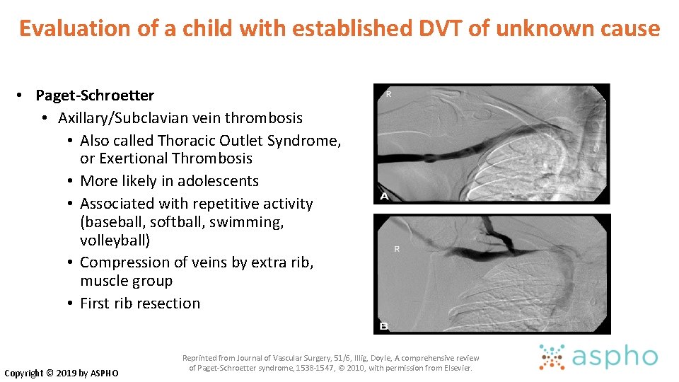 Evaluation of a child with established DVT of unknown cause • Paget-Schroetter • Axillary/Subclavian Evaluation of a child with established DVT of unknown cause • Paget-Schroetter • Axillary/Subclavian