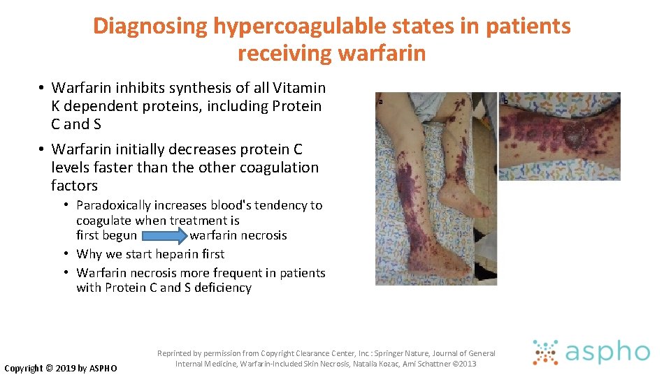 Diagnosing hypercoagulable states in patients receiving warfarin • Warfarin inhibits synthesis of all Vitamin Diagnosing hypercoagulable states in patients receiving warfarin • Warfarin inhibits synthesis of all Vitamin