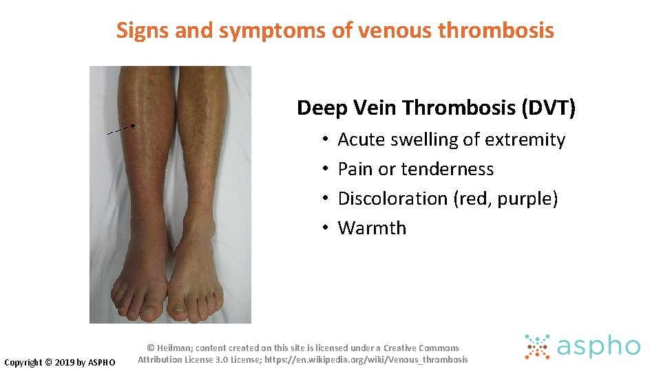Signs and symptoms of venous thrombosis Deep Vein Thrombosis (DVT) • • Copyright © Signs and symptoms of venous thrombosis Deep Vein Thrombosis (DVT) • • Copyright ©