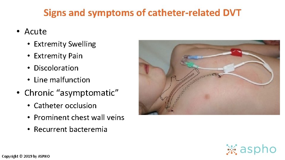 Signs and symptoms of catheter-related DVT • Acute • • Extremity Swelling Extremity Pain Signs and symptoms of catheter-related DVT • Acute • • Extremity Swelling Extremity Pain